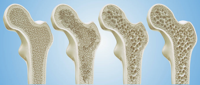 The Ultimate Guide to Strong Bones: 5 Foods to Avoid (Plus the One Nutrient You Need)